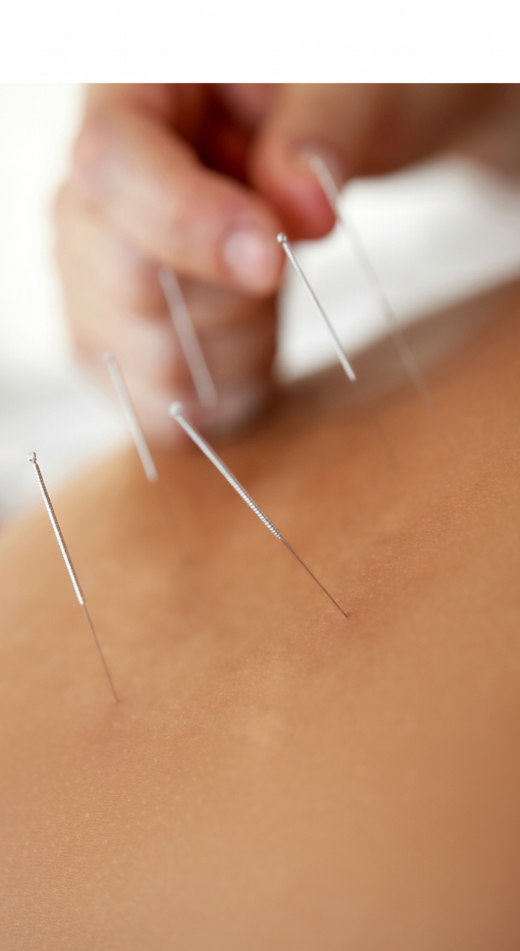 Acupuntura
